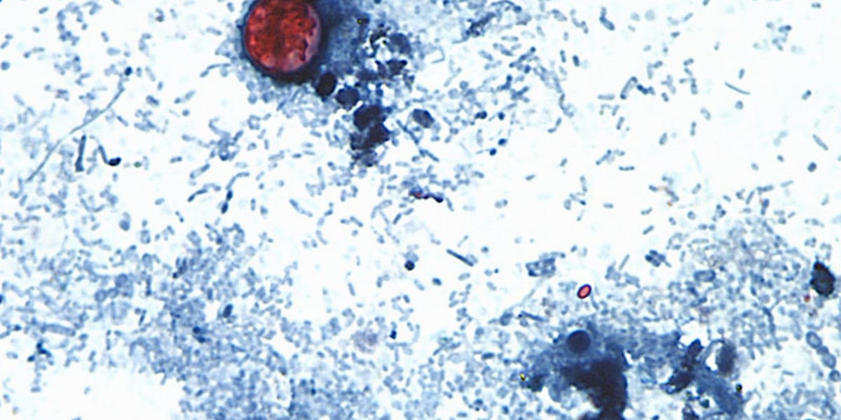 Cyclospora cases have increased in Douglas County, health officials say
