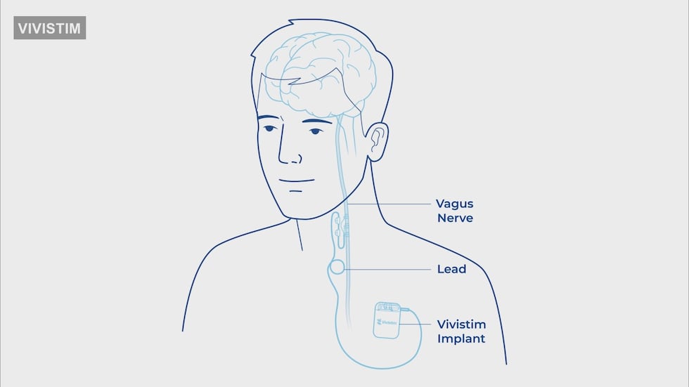 Vivistim implant diagram. Courtesy: Vivistim.